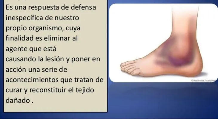 El ibuporeno y el paracetamol alivian el dolor y la inflamación, pero las altas dosis pueden causar problemas a la salud