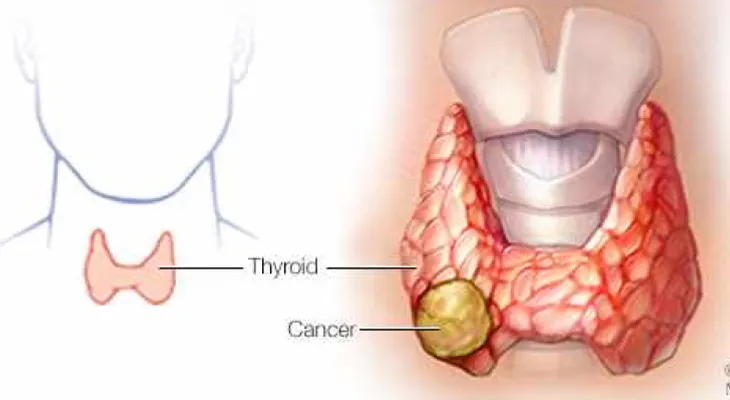La mayoría de los casos de cáncer de tiroides son curables