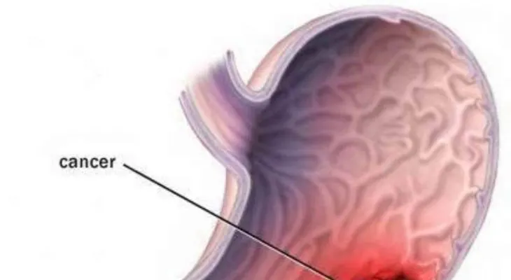 Cáncer de estómago una enfermedad silenciosa: Conoce los síntomas?