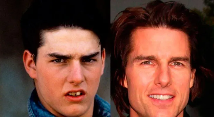 11 Personas famosas que tienen dientes falsos