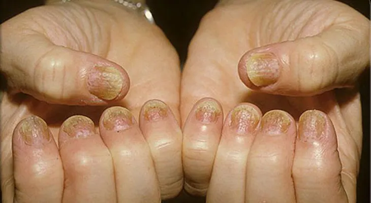 Tratamientos para la psoriasis en las uñas