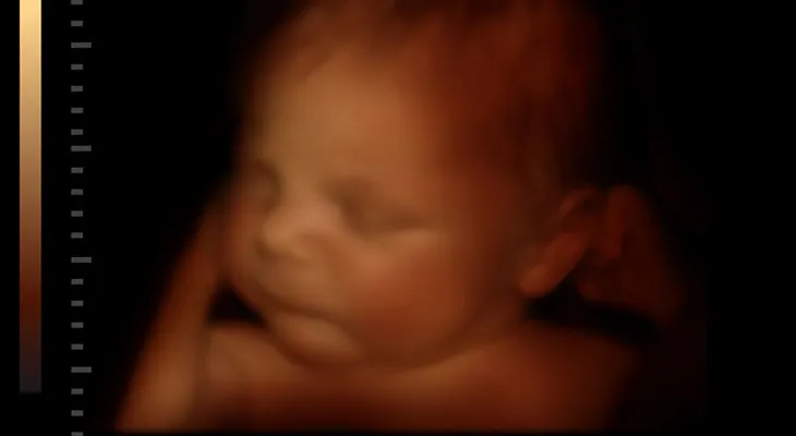 Bebé nace embarazada de gemelos en Hong Kong