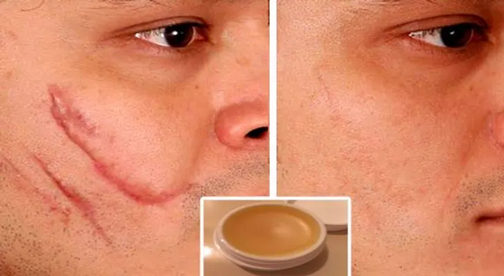 Para eliminar cicatrices de cualquier parte del cuerpo en 2 semanas prueba esta crema casera!