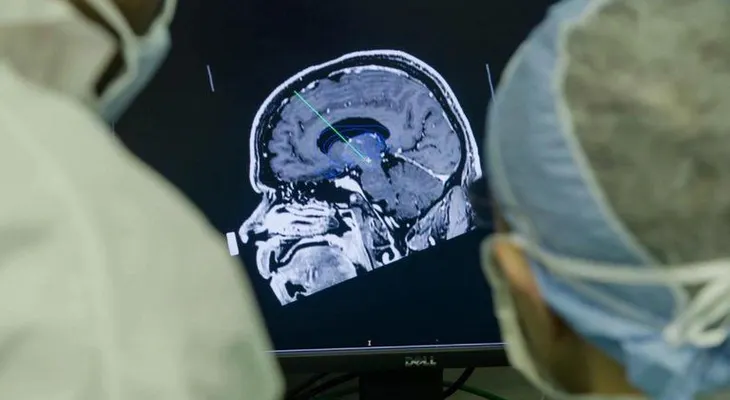 Un chip implantado en el cerebro podría ayudar a aliviar el dolor crónico