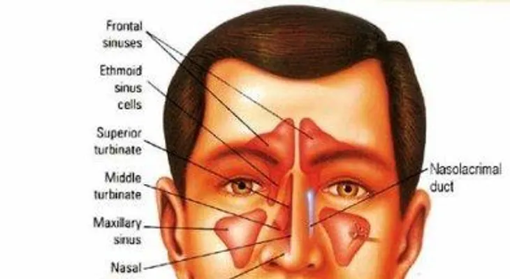 Remedios caseros para la sinusitis