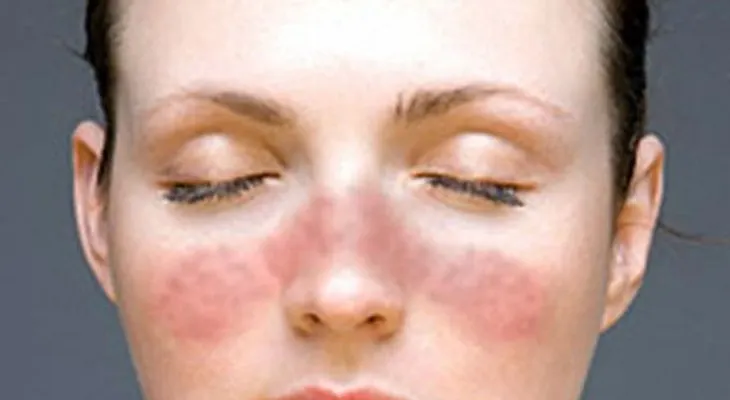 El mundo celebra esta noticia: Universidad de Florida descubre cura para Lupus