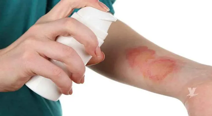  Desarrollan hidrogel para cicatrizar heridas y retorna la piel humana a su normalidad