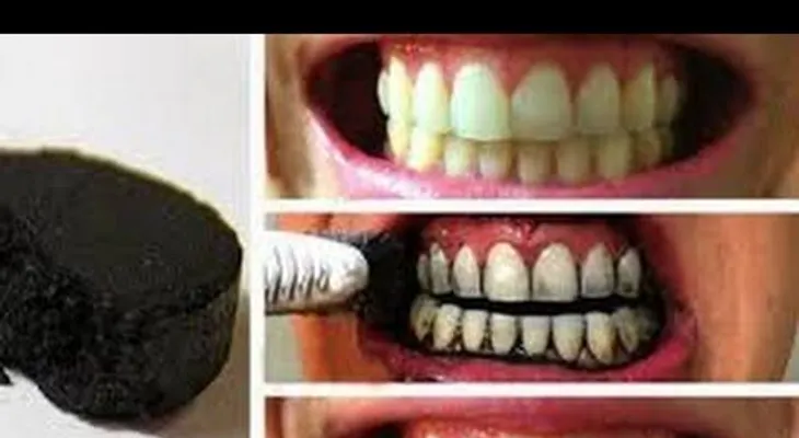 Los dentistas los ocultan a su conveniencia: elimina el sarro en 5 minutos (VIDEO)