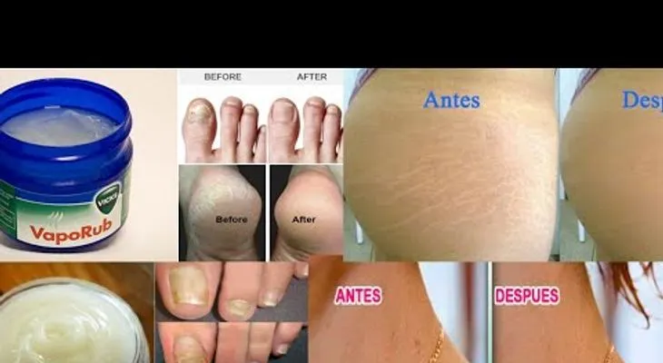 Nadie me lo dijo nunca: Los increíbles usos del VICKS VAPORUB 