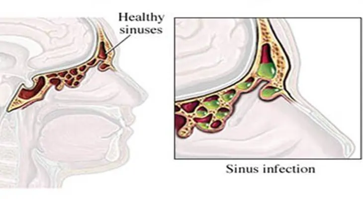 Cómo aliviar tu infección sinusal en 20 segundos