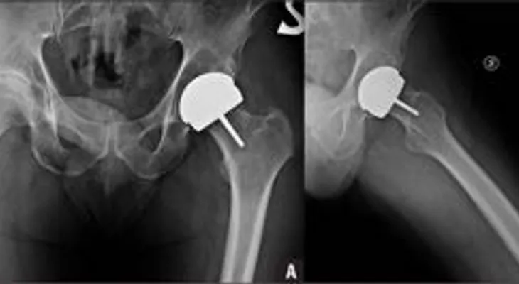 Denuncian práctica de cambiar implantes