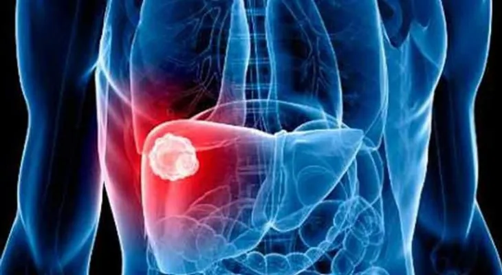 Desarrollan método para diagnosticar hígado graso 
