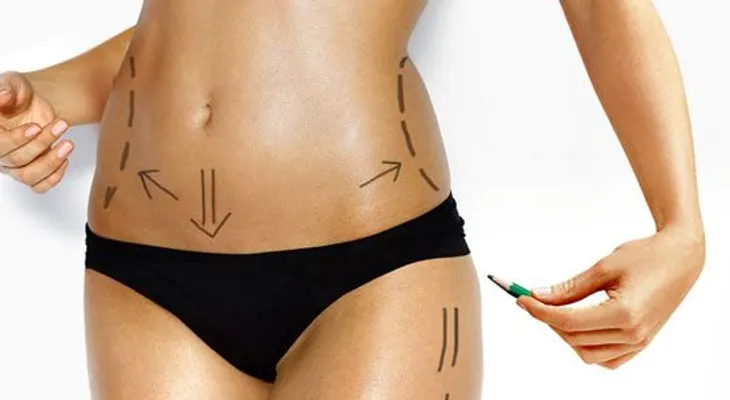 Estudio revela consecuencias  de la liposucción