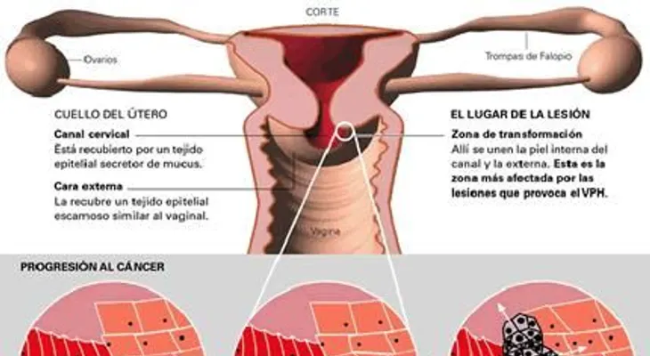 Qué es, y cómo se transmite, el virus del papiloma humano ?