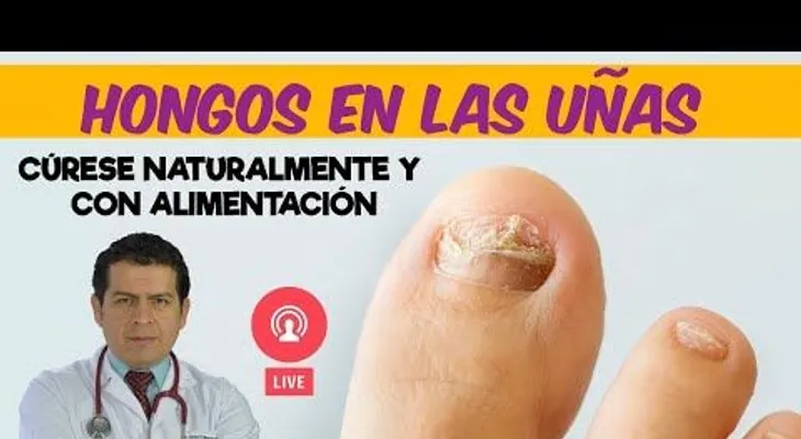 Tratamiento natural para los hongos en las uñas, revelado por el doctor Javier Moreno