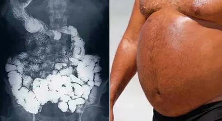 Con esto mi abuelo eliminó para siempre la hinchazón en su panza. Informate
