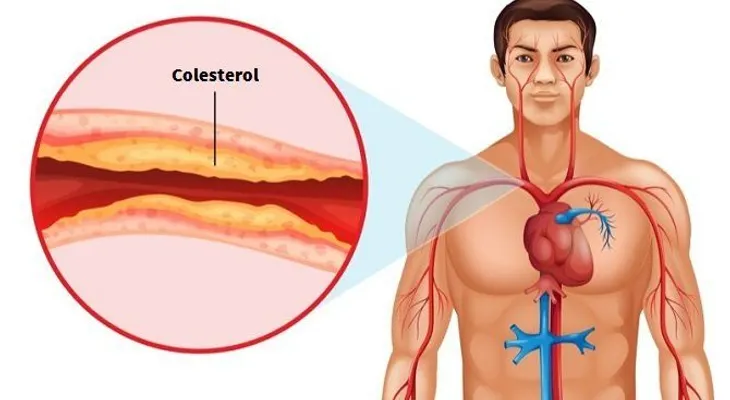 Cómo destapar las arterias del corazón con remedios naturales