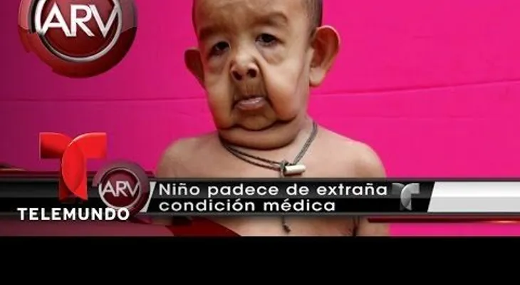 Un niño con una rara enfermedad que lo hace ver como un anciano