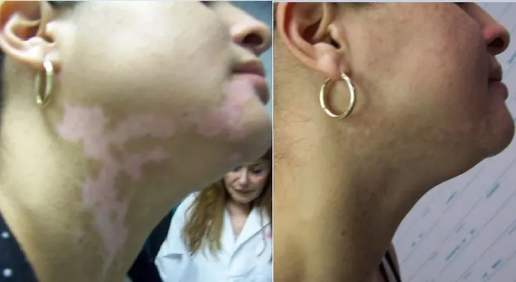 El mundo celebra; cientificos cubanos descubren la cura del vitiligo