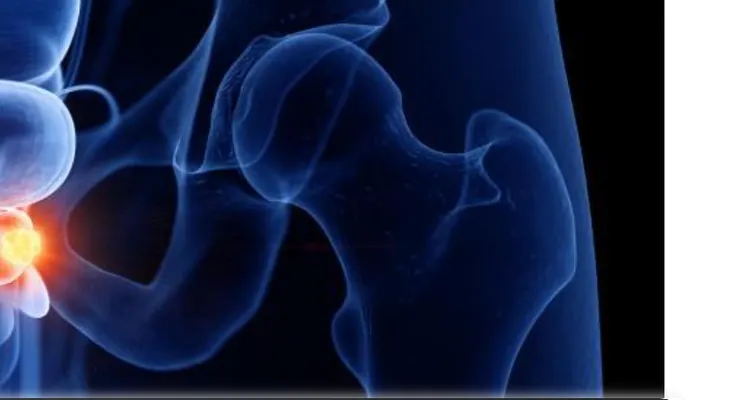 Avance contra cáncer de próstata