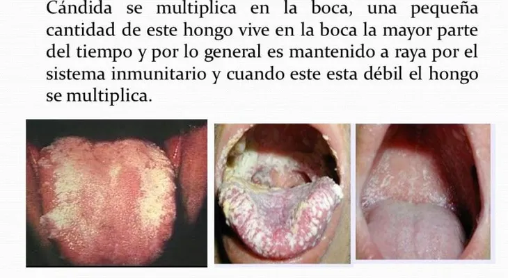 ¿Cómo se cura la candidiasis?