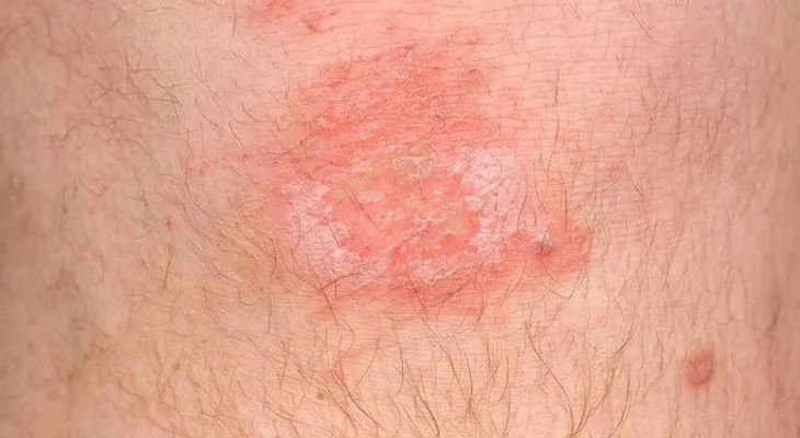 6 remedios para las úlceras de la pierna