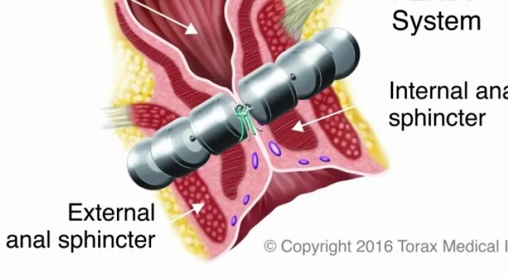 Mayo Clinic es la primera en implantar dispositivo para la incontinencia fecal