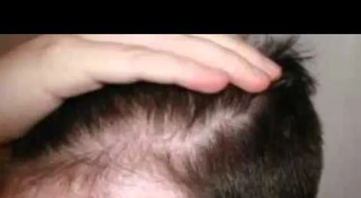 Un tratamiento para prevenir la caída del pelo (VIDEO)