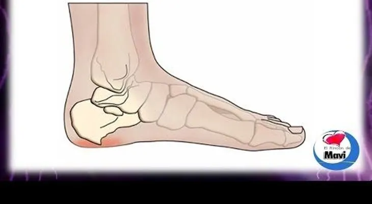 Cómo curar el dolor de talon (espolón) (VIDEO)
