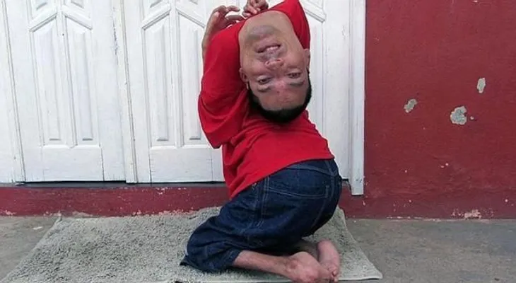 Historia del hombre que nació con la cabeza al revés