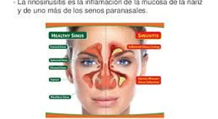 Rinosinusitis crónica puede afectar el sueño, el ejercicio y la actividad física