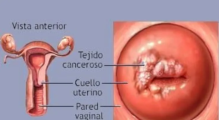 Brasil comienza a vacunar a los niños contra el virus del papiloma humano