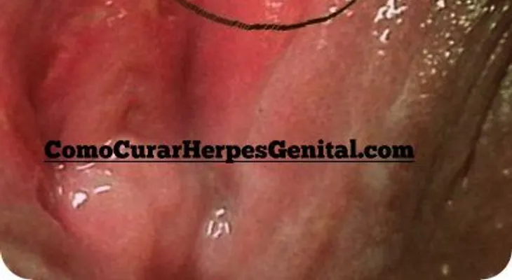 Cómo curar la candidiasis genital masculina