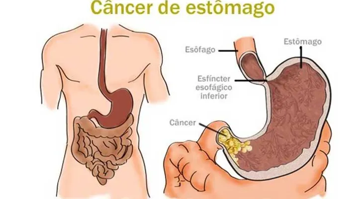 Estas señales me alertaron que tenía comienzo de un cáncer SILENCIOSO de estómago y pude evitarlo