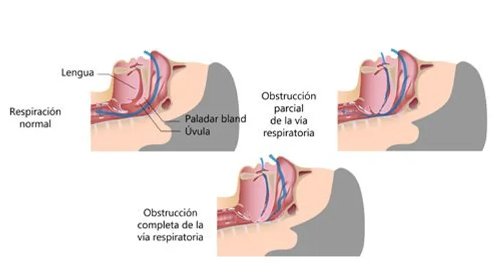 Tratamientos naturales para los ronquidos