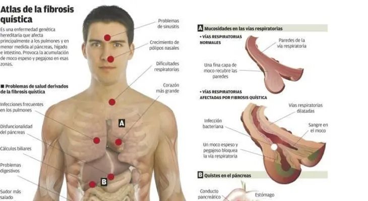 Fibrosis Quística; causas y tratamiento (VIDEO)