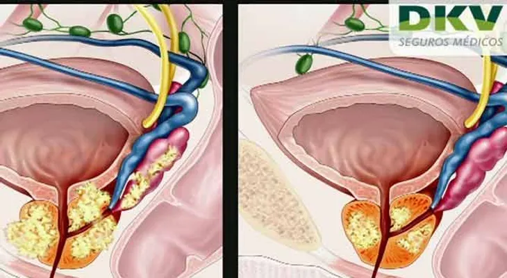 Video: ¿Que es la próstata, y cómo prevenir la enfermedad? 