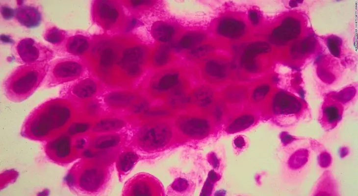 ¿Puedes vacunarte a ti mismo contra el cáncer?