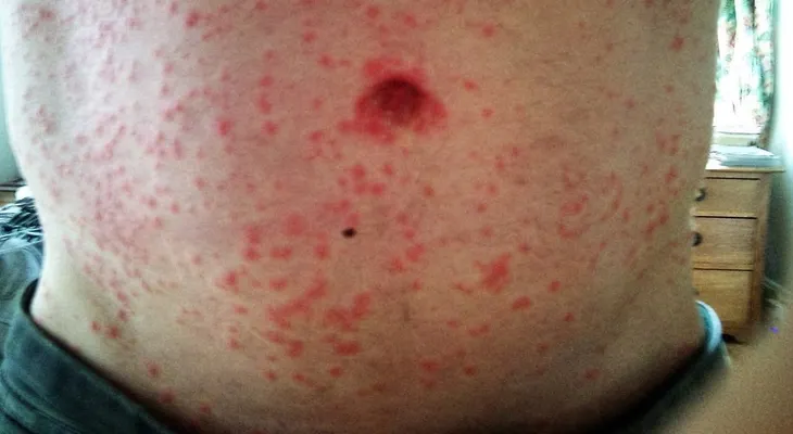 Virus El Mayaro detectado en Haití, tiene preocupado a dominicanos; SP vigila 