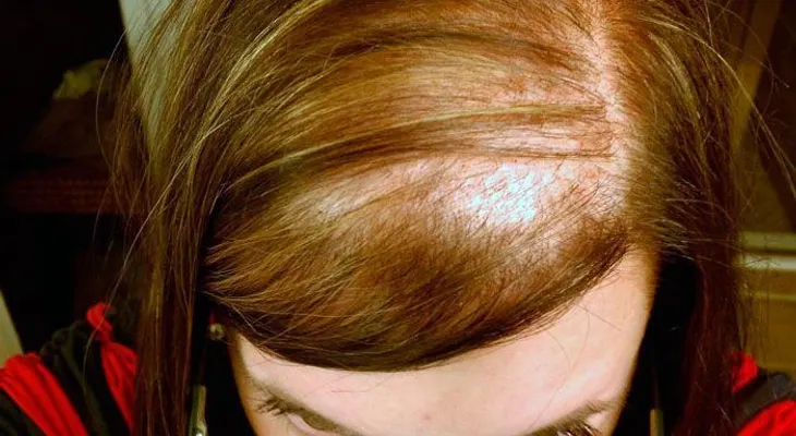 La alopecia (caída del cabello) y su aparición luego del embarazo