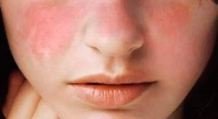 Lupus, la enfermedad autoinmune que azota al cuerpo