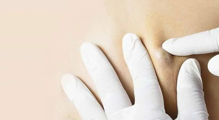 Quistes en las axilas causas y cuando acudir al médico