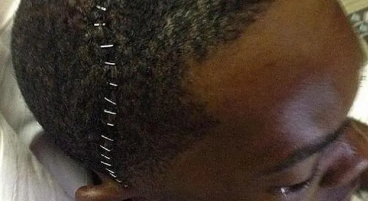 Aroldis Chapman sube a las redes foto de su cabeza grapada tras cirugía 