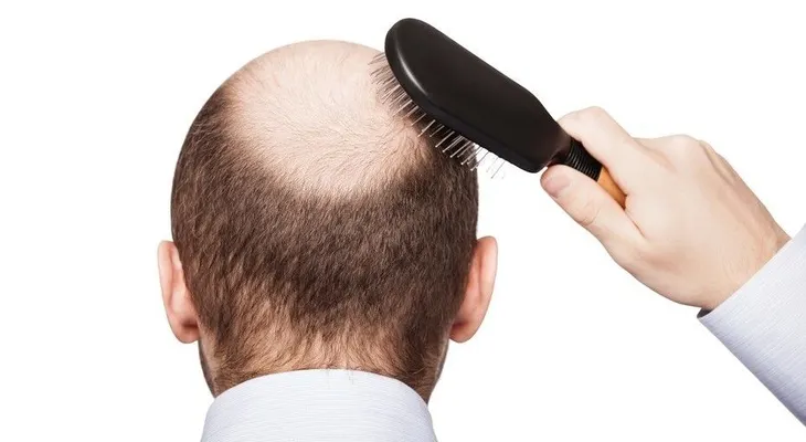  Estudiantes crean tratamiento para combatir alopecia a base de nuez 