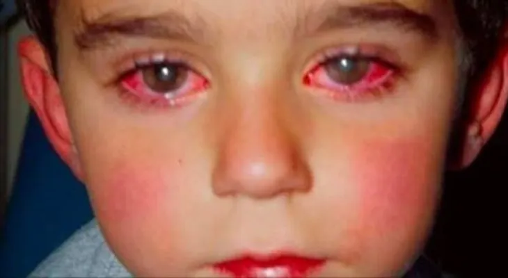 Quemadura en los ojos: Un niño perdio la vista a causa de este juguete que probablemente tengas en tu casa