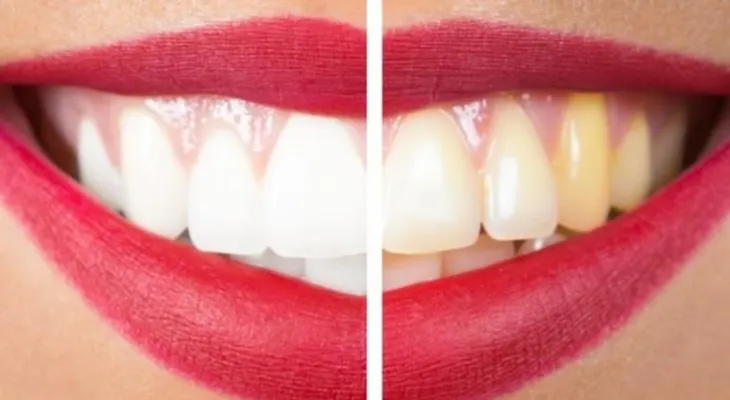 Anota estos remedios que no fallan para blanquear los dientes