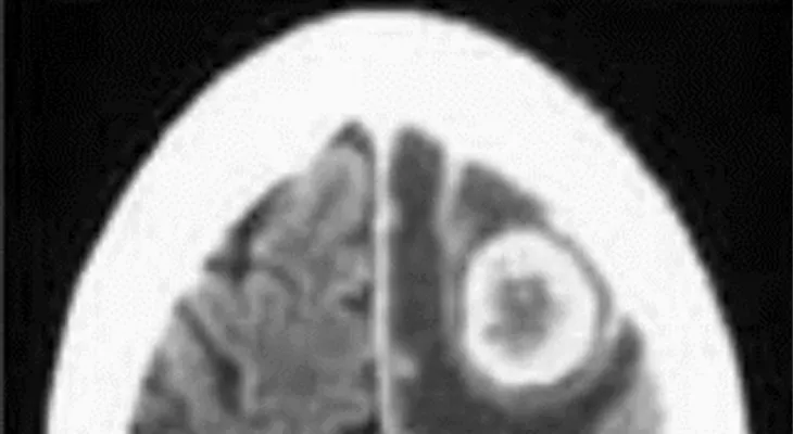 Cáncer de mama hace metástasis en el cerebro