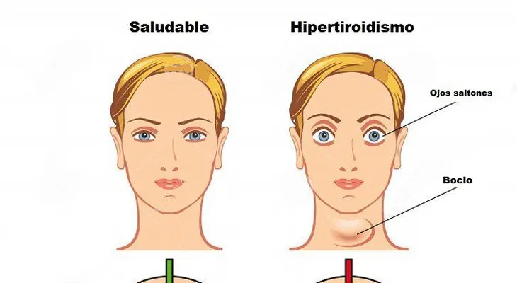 5 Remedios caseros para tratar el hipertiroidismo