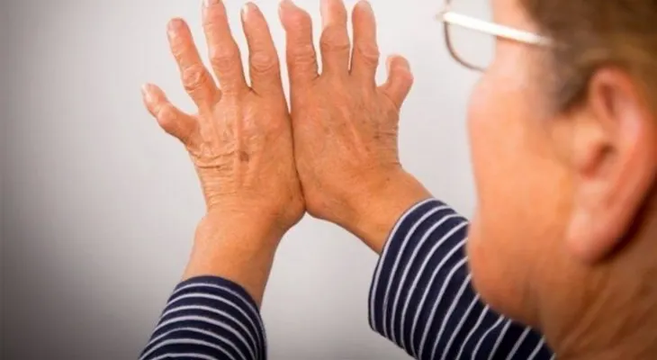 Diagnóstico temprano de la artritis reumatoide evita la incapacidad de los pacientes 