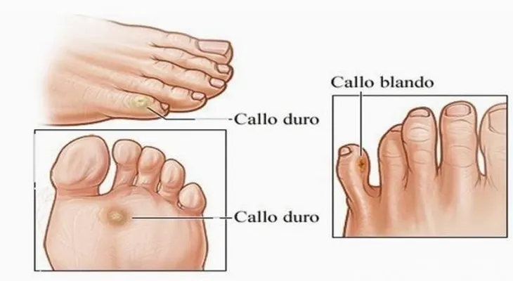 Los callos se te quitan para SIEMPRE con este simple remedio